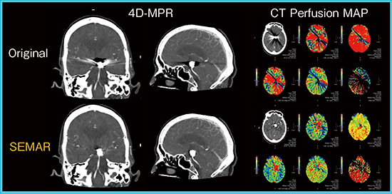 図2　SEMARによるCT Perfusion画像