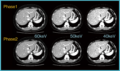 図4　ディープラーニングの学習の更新による画質改善 Spectral Scan（135-80kV），AEC：162〜266mAs（0.5s/r），FOV：L，PF0.812，12.5mGy