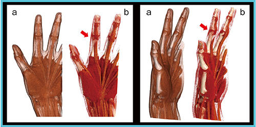 図5　Global Illuminationによる深指屈筋の腱断裂の描出 a：従来3D処理　b：Global Illumination