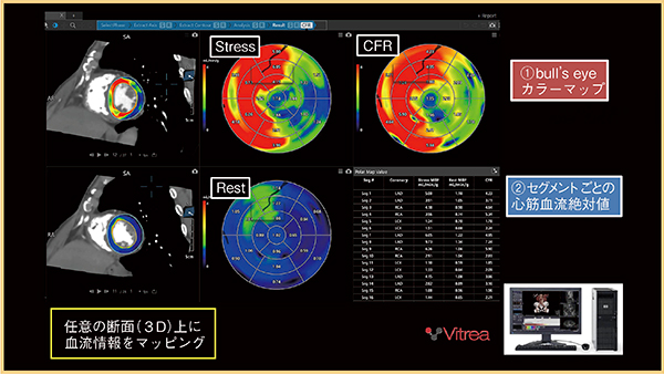 図3　Vitreaで得られる心筋血流解析