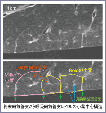 図1　摘出肺の高精細CT画像2）