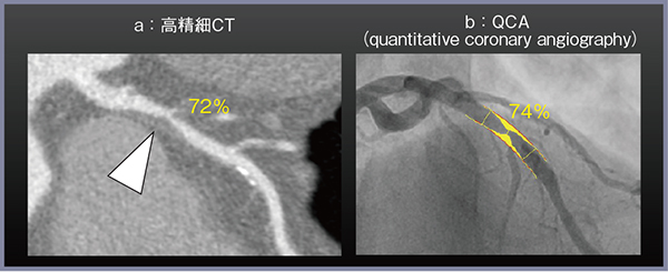 図1　冠動脈狭窄の定量評価