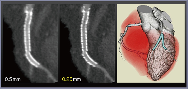 図2　高精細CTによる小径ステントの評価 対角枝 2.5mmステント