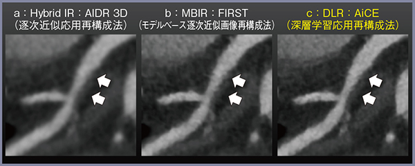 図3　冠動脈評価における画像再構成法の比較