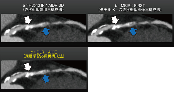 図4　高度石灰化病変評価における画像再構成法の比較