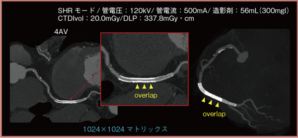 図1　材質や径の異なるステントやステントの重なりの評価 60歳代，50kg，3.5mmのプラチナ合金ステントと2.5mmのコバルトクロム合金薬剤溶出ステント（DES）留置例。ステントの径や材質の違いも表現されており，ステントが重なっている部分（▲）も明瞭である。