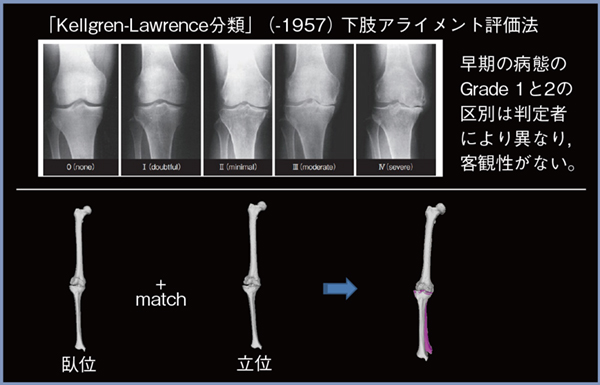 図1　変形性膝関節症の早期診断