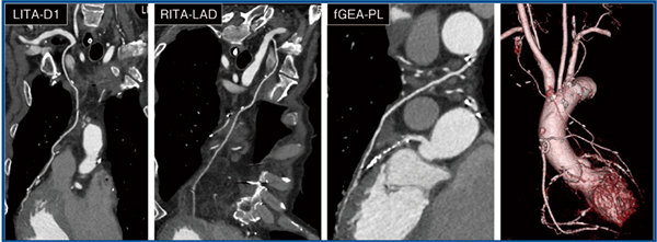 図3　CABG後評価目的のCTA
