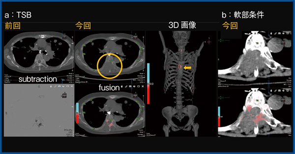 図3　大腸がん術後，下肢麻痺