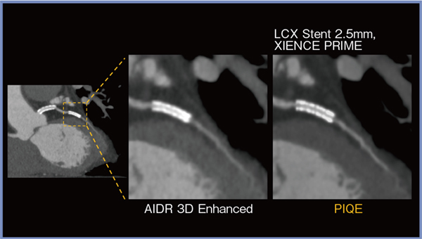 図1　PIQEによる小径ステントの内腔の評価