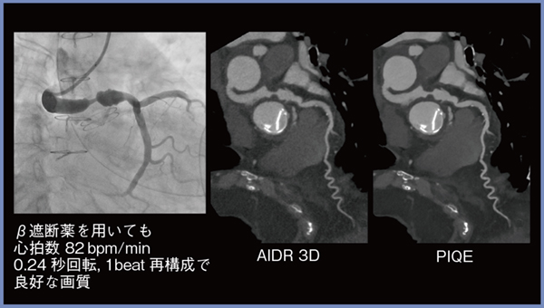 図3　高心拍症例（0.24s/rot 1beat撮影）