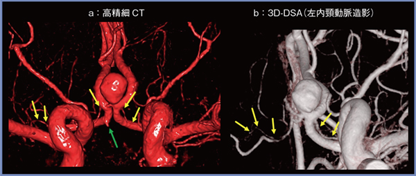 図1　前交通動脈瘤