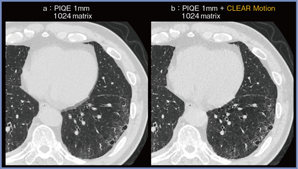 図5　例4：間質性肺炎症例へのCLEAR Motionの適用