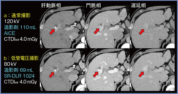 図4　症例2：肝硬変・肝血管腫（60歳，男性）