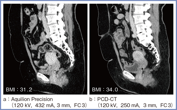 図4　相対的に線量が不足する患者の腹部CTにおけるPCD-CTの画質