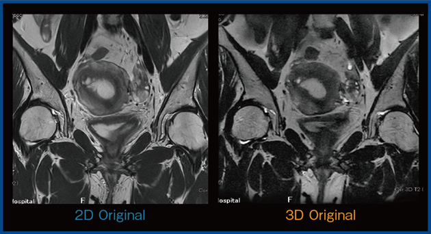 図7 女性骨盤の撮像における2D法(PIQE適用)と3D法の比較 図7 女性骨盤の撮像における2D法(PIQE適用)と3D法の比較