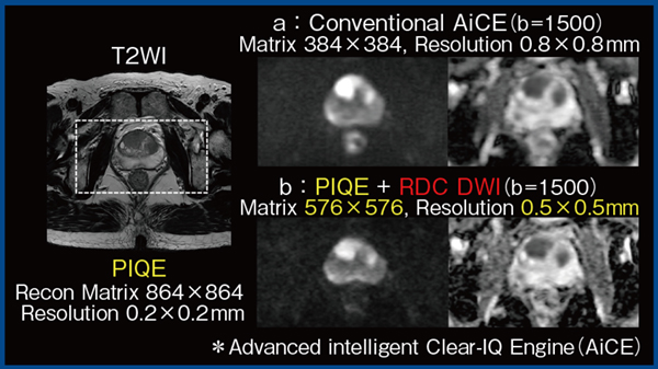図2 PIQEの適用拡大:RDC DWIの画質向上(前立腺がん) 図2 PIQEの適用拡大:RDC DWIの画質向上(前立腺がん)