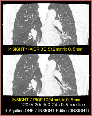 図5　超解像画像呼吸動態CT（肺がん症例）
