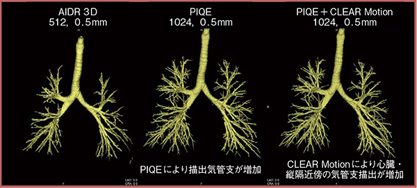 図6　CLEAR Motionによる気管支樹描出の向上
