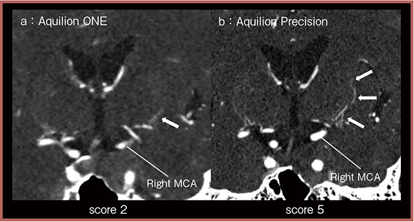図1　Aquilion Precisionによる頭蓋内細動脈の描出の評価