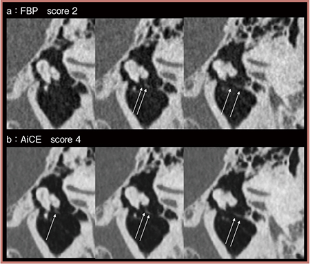 図4　AiCE INNER EARにおける中内耳の微細構造（鼓索神経）の描出の評価