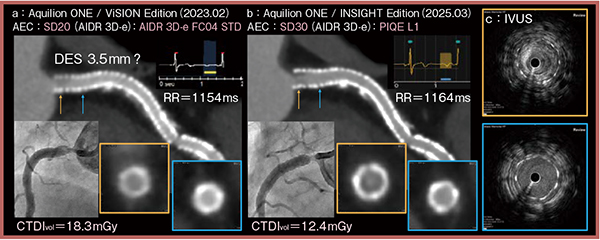 図2　症例1：右冠動脈のPCI後フォローアップ