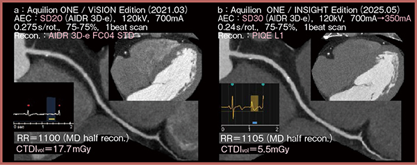 図3　症例2：狭心症疑い
