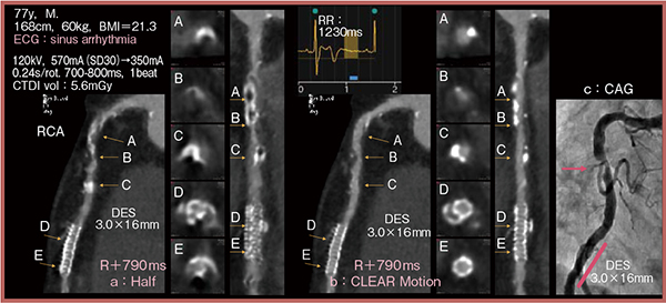 図4　症例3：洞不全症候群