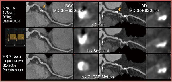 図6　症例4：拡張中期位相の比較（curved MPR, cross section：↓）