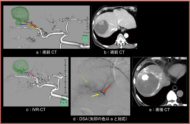 図2　症例1：70歳代，男性，肝細胞がん再発