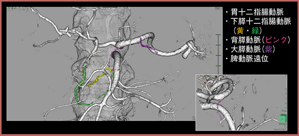 図3　症例2：80歳代，男性，インスリノーマ