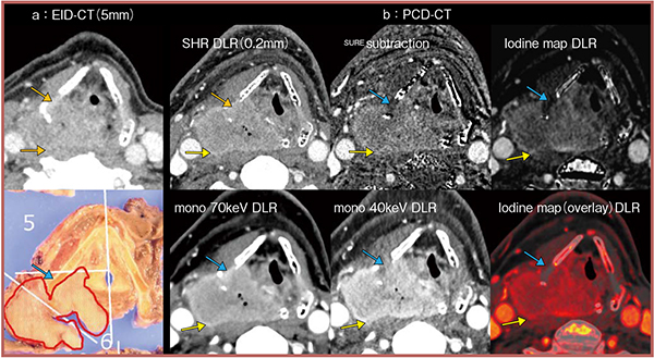図3　PCD-CTによる軟骨および椎前筋への浸潤の評価
