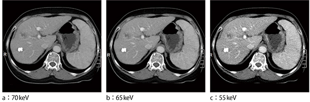 図1　仮想単色X線画像における造影コントラストの違い（撮影線量：10.7mGy） （画像ご提供：The Fourth Hospital of Harbin Medical University, China）