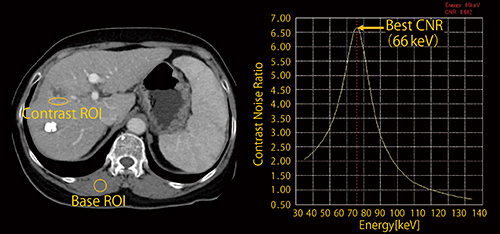 図2　Best CNR （画像ご提供：The Fourth Hospital of Harbin Medical University, China）