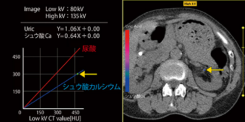 図3　尿酸結石とシュウ酸カルシウム結石の弁別（画像はシュウ酸カルシウムの例） （画像ご提供：医療法人仁友会北彩都病院・山口　聡先生）