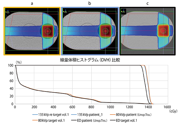 図4　従来法による電子密度値とDECTによる電子密度値との線量計算比較 a：80kVp画像　b：135kVp画像　c：DECTによる電子密度画像 80kVpと135kVpでの従来法による計算結果はほぼ一致しているのに対し，DECTによる電子密度値は3.9％の差が見られた（DECTの方が真値に近い）。 （画像ご提供：東京大学医学部附属病院・野元昭弘先生）