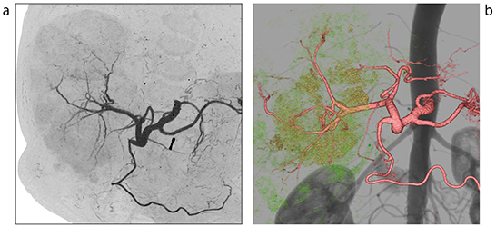 図2　肝腫瘍CTA例 0.25mm，1024マトリックス画像より再構築したMIP画像（a），VR画像（b）