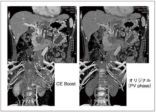 図5　CE Boost適用例（膵頭部腫瘍例）