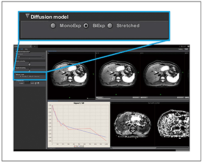 図6　VitreaでのIVIM解析画面 フィッティングモデルとして，mono-exponential model，bi-exponential model，stretched modelを選択できる。