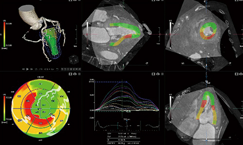 図3　US Cardiac Fusionの壁運動情報表示例 （データご提供：岡山大学・高谷陽一先生）