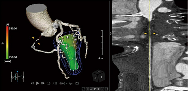 図4　US Cardiac Fusionの狭窄解析情報とランドマーク表示例 （データご提供：岡山大学・高谷陽一先生）