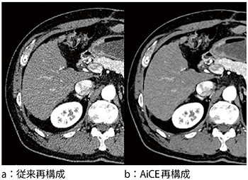 図1　従来再構成とAiCE再構成の画像比較 （データご提供：国立がん研究センター中央病院様）