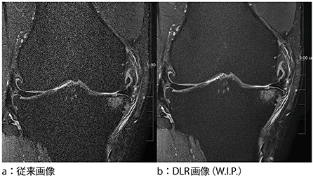 図2　膝関節2D 1mmスライス画像（撮像時間1：07）での比較