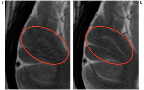 図1　PURERF RXによるSNRの向上 a：PURERF RXなし　b：Orian SNRの向上により，細かな構造などが明瞭に描出されている。 ＊当社1.5T MRI装置との比較