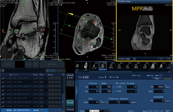 図4　ForeSee Viewによるプランニング画面 ForeSee Viewでは，撮像断面設定中にリアルタイムにMPR断面を表示することができる。