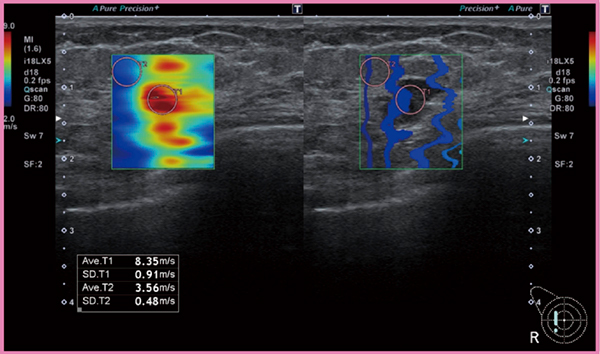 図3　乳腺のSWE像（画像提供：名古屋医療センター・森田孝子先生）