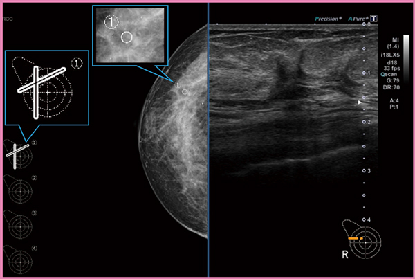 図5　マンモグラフィ画像と超音波画像の2画面表示（画像提供：高松平和病院・何森亜由美先生）