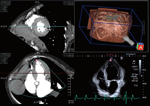 図1　CTと心エコーの4CV像のSmart Fusion表示 （画像ご提供：聖マリアンナ医科大学・出雲昌樹先生）