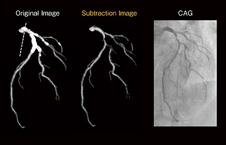 図5　サブトラクション処理前後とCAGとの比較 （画像ご提供：磐田市立総合病院様）