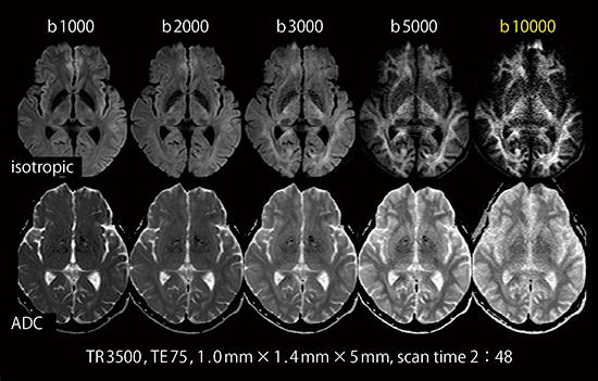 図3　High b value DWI